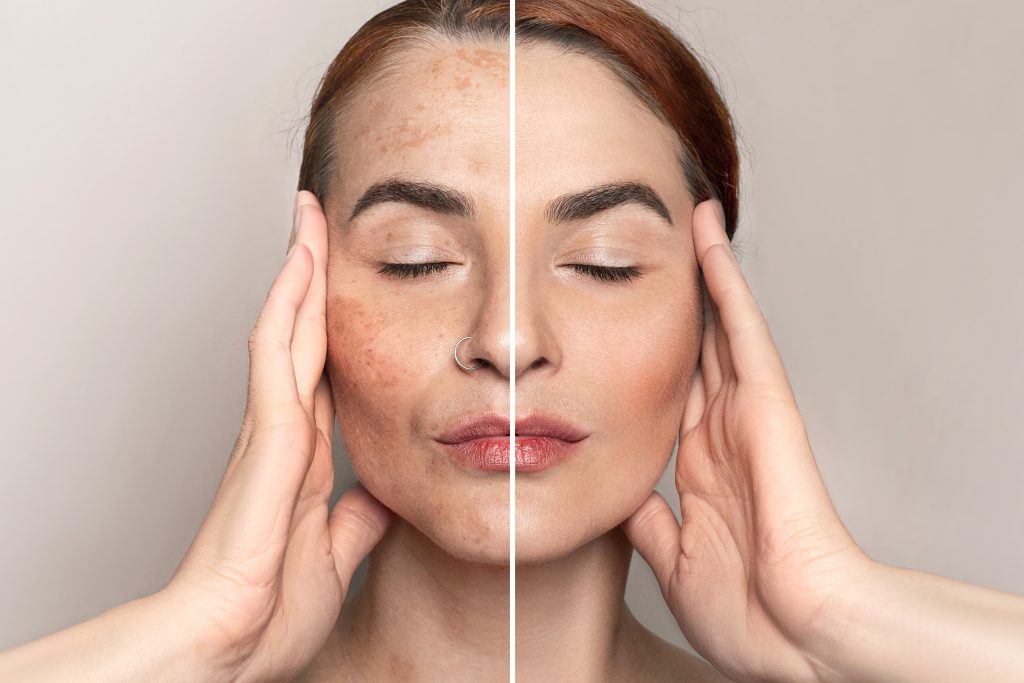 before, after portrait of woman after laser or cream treatment removing freckles or pigment on face with pigmentation, melasma, freckles, age spots photo. close up photo