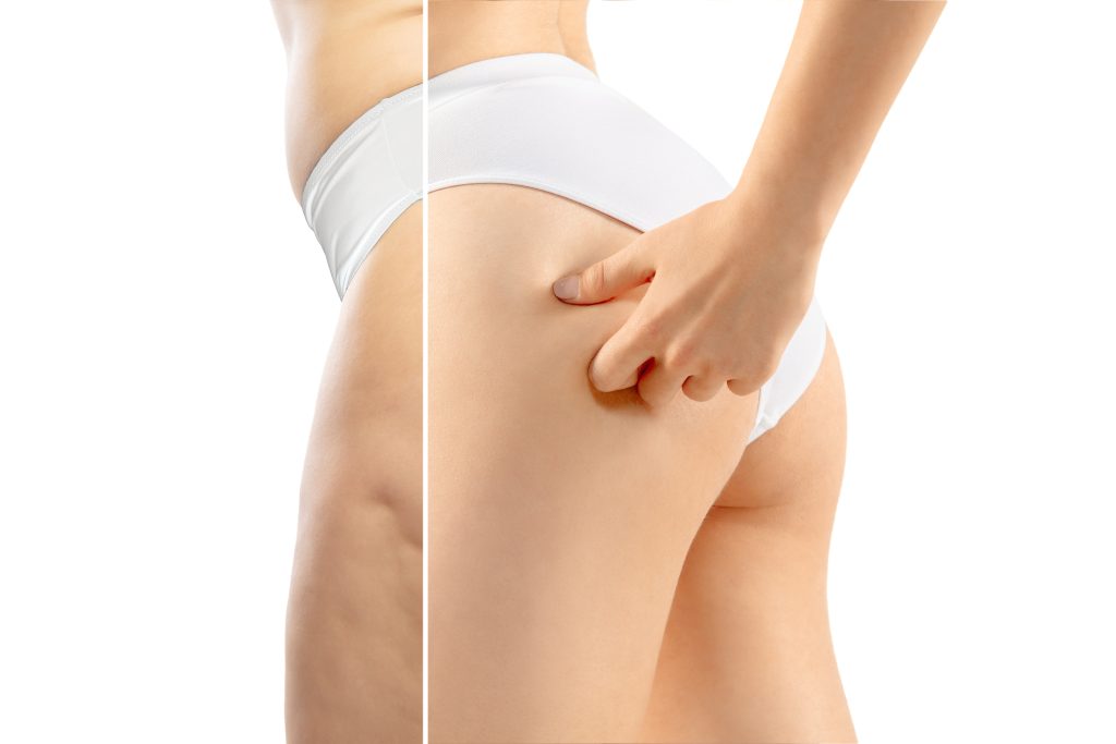 overweight woman with fat cellulite legs and buttocks, obesity female body in white underwear comparing with fit and thin body isolated on white background