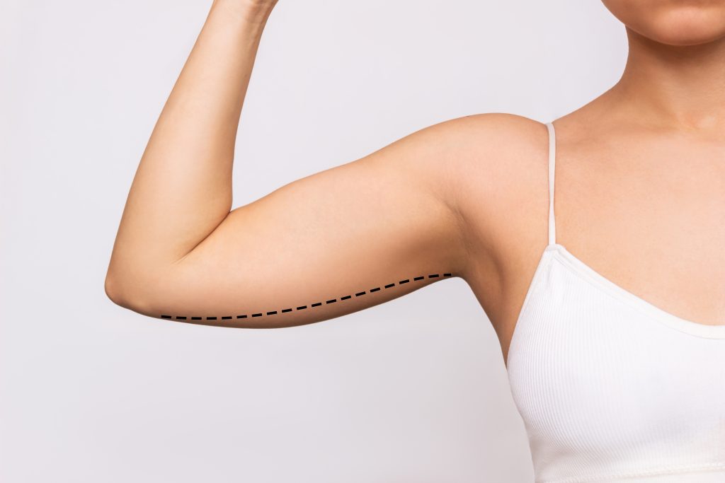 young woman with excess fat her upper arm with marks liposuction plastic surgery